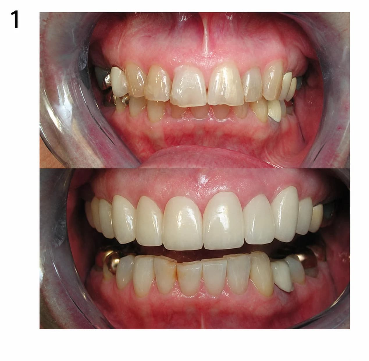 Before and after porcelain veneers by Dr. Andy Engel — Case 01