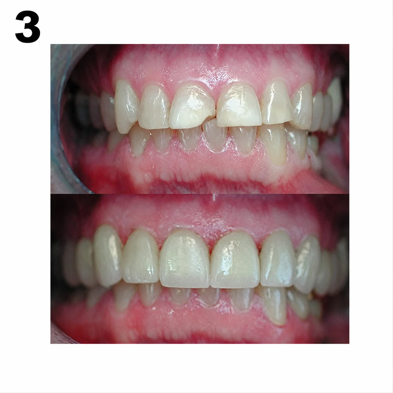 Before and after porcelain crowns by Dr. Andy Engel — Case 03